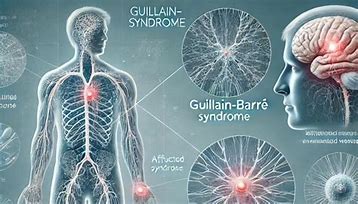 Guillain-Barre Syndrome